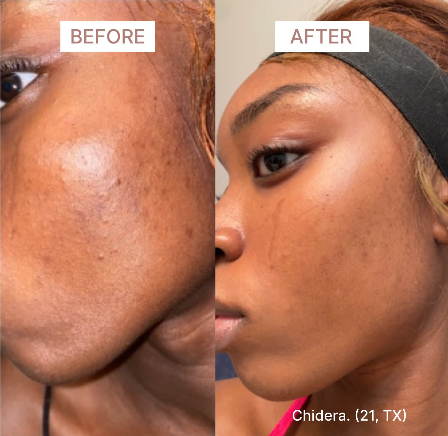 before-and-after-pictures-musely-dark-spot-cream-.jpeg