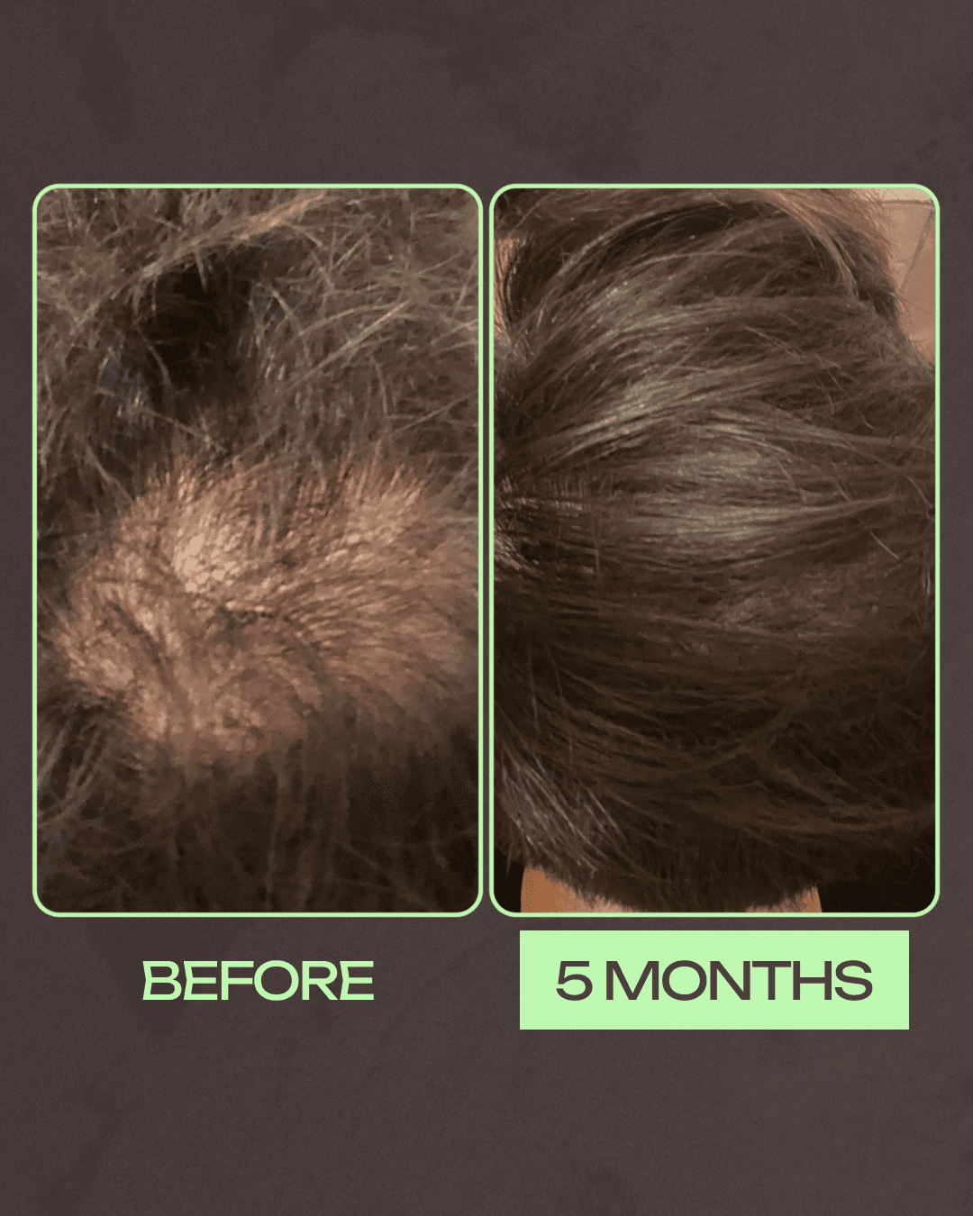 Happy Head vs. Hims vs. Keeps: Best & Worst ways to regrow hair! — hims-before-and-after-picture-.png