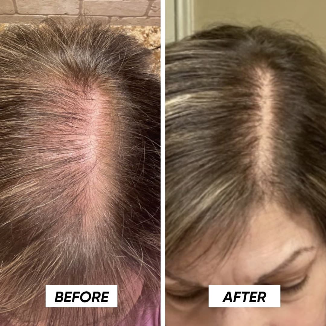musely-hair-loss-treatment-.jpeg