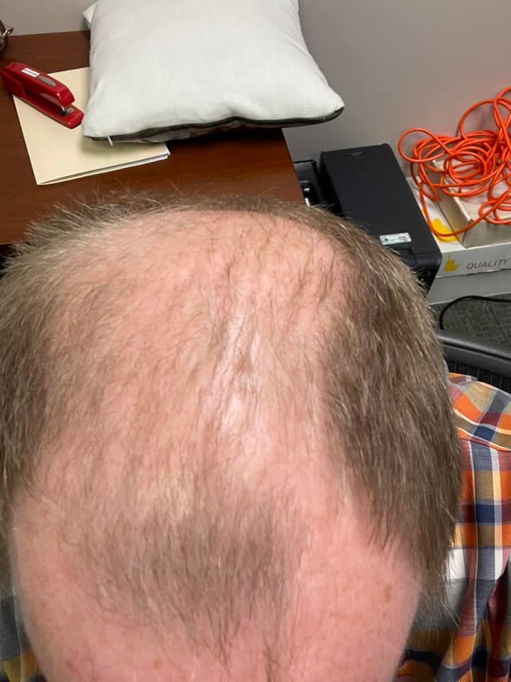 Happy Head vs. Hims vs. Keeps: Best & Worst ways to regrow hair! — happyhead-hair-growth-review-before-.jpeg