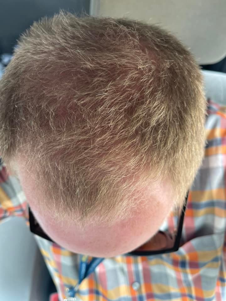 Happy Head vs. Hims vs. Keeps: Best & Worst ways to regrow hair! — review-after-happy-head-hair-growth-treatment-.jpeg