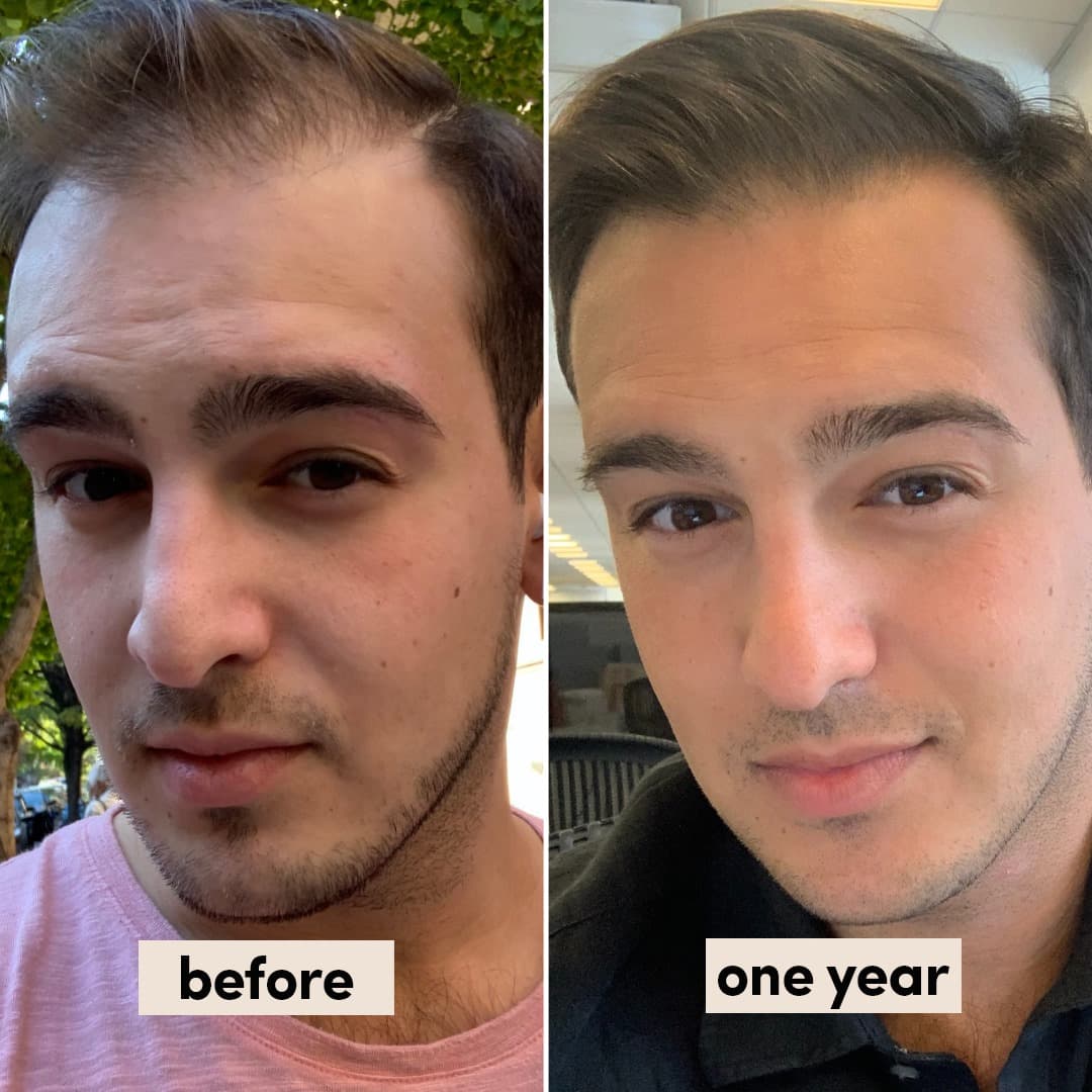 hims customer review (before and after 1 year picture)