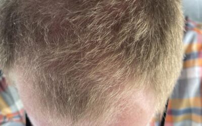 Roman Hair Loss Review