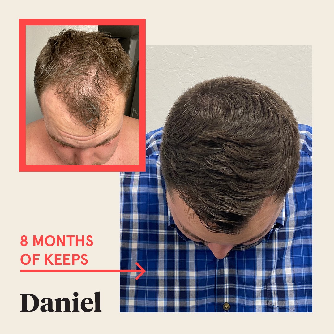 This picture illustrates a man who has experienced hair loss on the top of his head, as evidenced by his receding hairline. However, within just 8 months, his hair has noticeably grown thicker and fuller, with no visible traces of a receding hairline.