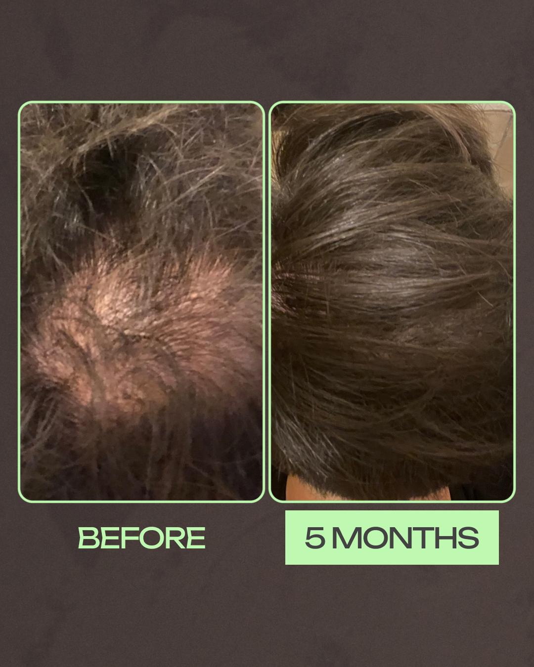 Here's a before and after picture taken by a Happy Head customer. The top image was after 6 months of treatment. 